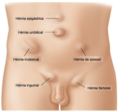Tipos de hérnia e como reconhecer